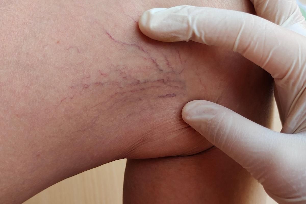 La trombose est la troisième cause de mortalité cardiovasculaire après l’infarctus et l’AVC.