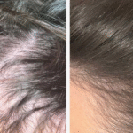 Femme souffrant de perte de cheveux révèle une repousse éclatante après avoir pris un comprimé à 43 pence par jour