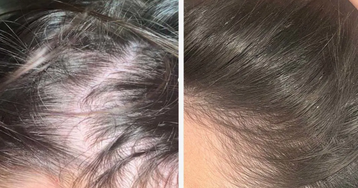 Femme souffrant de perte de cheveux révèle une repousse éclatante après avoir pris un comprimé à 43 pence par jour