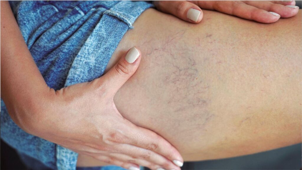 Augmentation des pathologies veineuses : Alerte des spécialistes Vithas