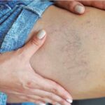 Augmentation des pathologies veineuses : Alerte des spécialistes Vithas