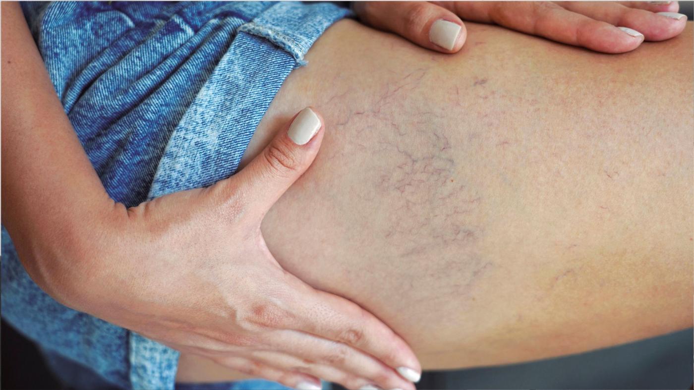 Augmentation des pathologies veineuses : Alerte des spécialistes Vithas