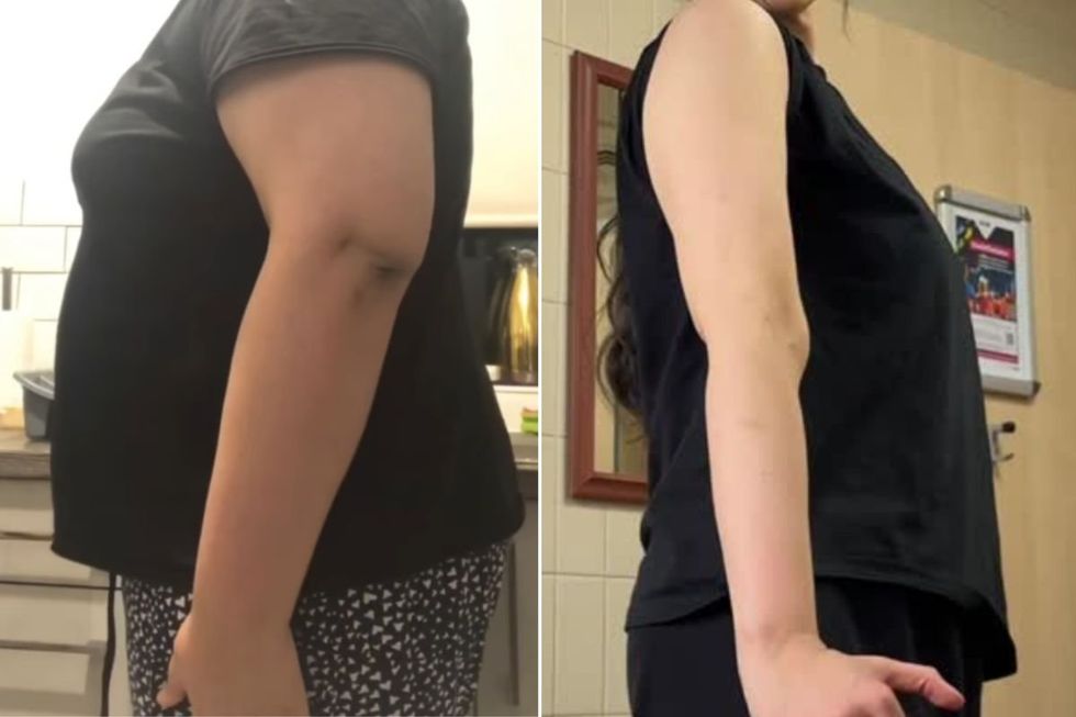 Transformation des bras - Avant et Après